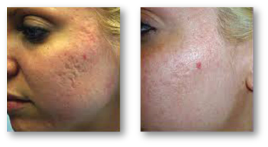 woman's cheek before and after skin rejuvenation treatment for acne and scarring