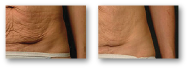 woman's stomach fat before and after treatment at medical spa