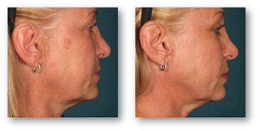 side view of older woman's jowls before and after skin tightening treatment