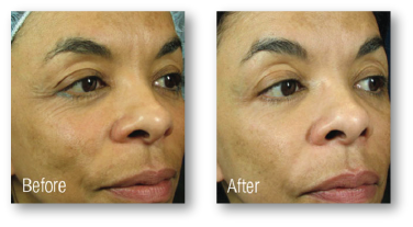 before and after skin rejuvenation treatment for skin discoloration