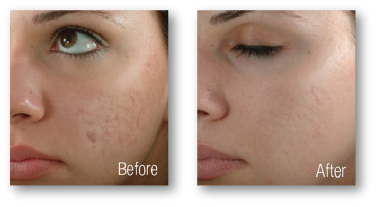 woman's cheek before and after skin rejuvenation treatment for acne scars