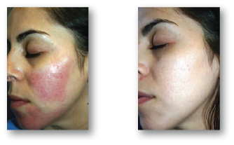 woman's cheek before and after skin rejuvenation treatment for discoloration