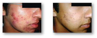 man's cheek before and after skin rejuvenation treatment for acne