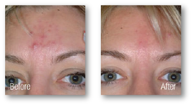 woman's forehead before and after skin rejuvenation treatment for acne